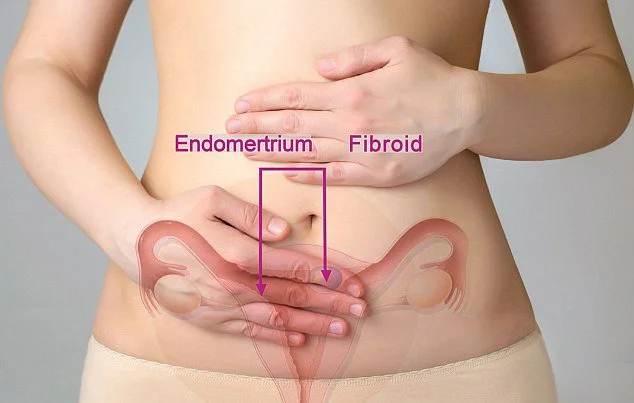 ENDOMETRIOSIS WHAT’S THE URGENCY ?