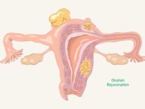 Ovarian Rejuvenation