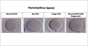 Oocyte Grading