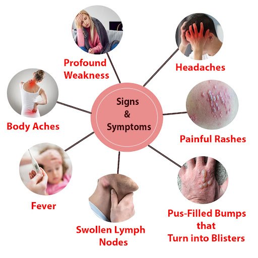 Monkeypox virus Signs & Symptoms