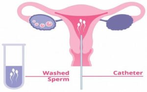 IUI success rate