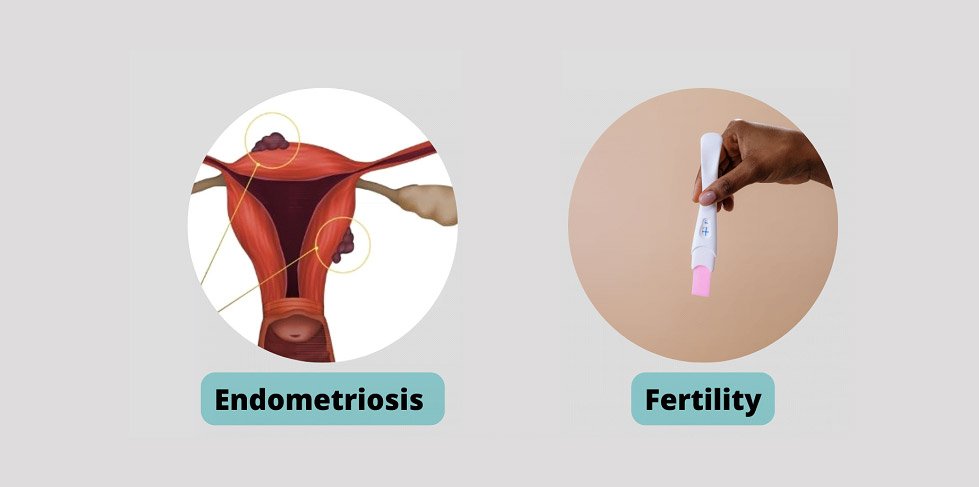 ENDOMETRIOSIS & FERTILITY : 3 Reasons for women to have hope